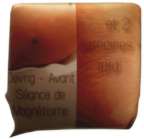 témoignage magnétiseur magnétisme verrue plantaire Dévrig Corbel Sylvie Marrec 