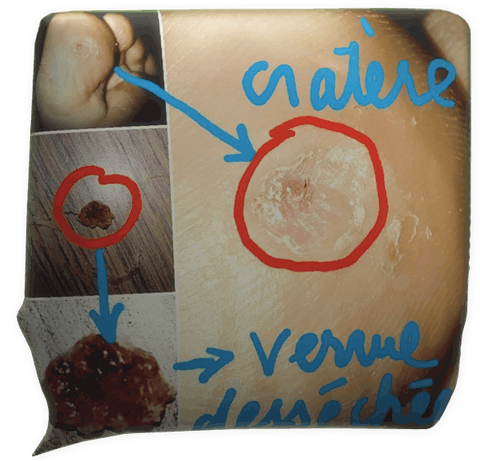 témoignage magnétiseur magnétisme verrue plantaire Julie Dréo Riec sur Belon