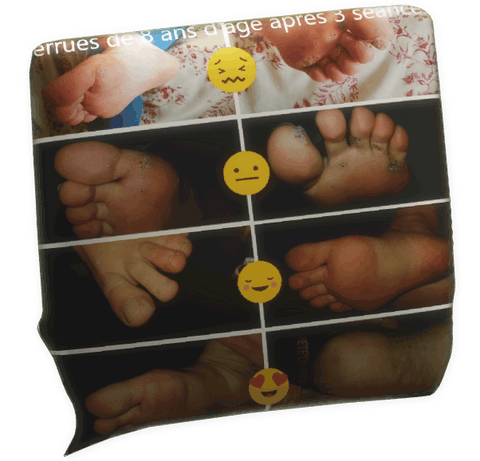 témoignage verrue plantaire Sandra Autret pour Fabrice Corazza magnétiseur guérisseur coupeur de feu Locunolé