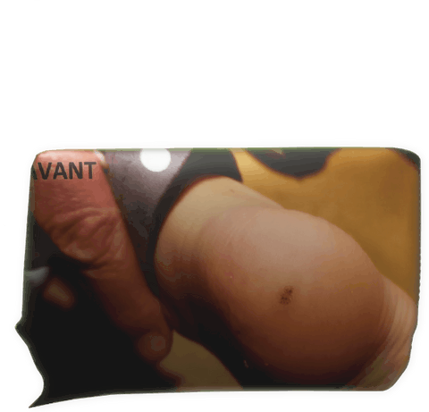 verrue plantaire Enora Laëtitia Scuiller