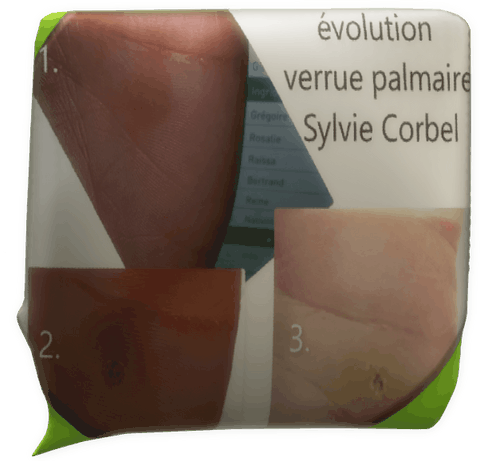 témoignage magnétiseur Sylvie Corbel verrue palmaire Quimperlé